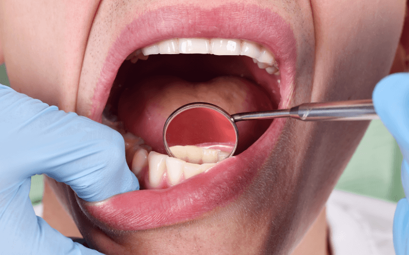 The effects associated with putting off fixing your cracked or chipped tooth