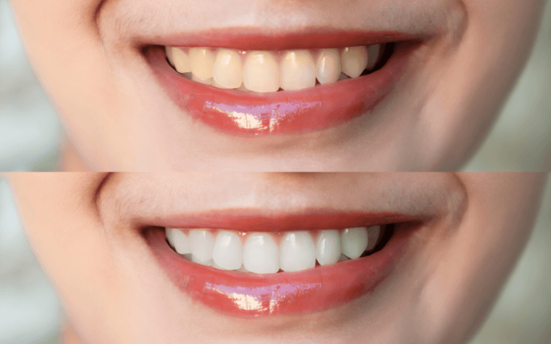 How to Maintain Your Smile After Teeth Whitening (1)