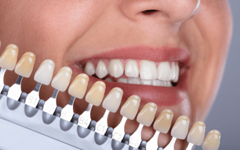 Myths and Facts About Teeth Whitening